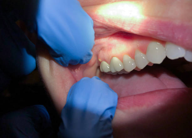 Best Emergency Dentist for Lost Fillings or Crowns in Folsom, CA